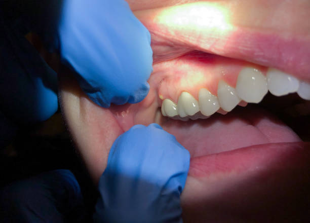 Best Root Canal Emergency Dentist  in Shadyside, OH