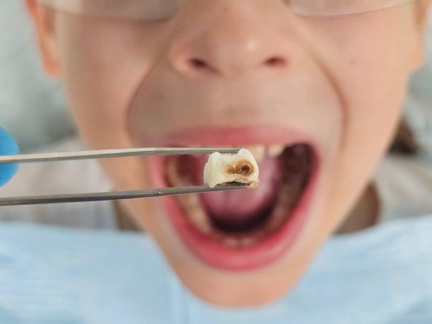 Best Dentist for Tooth Abscess  in Shadyside, OH